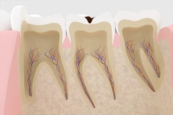 エナメル質の虫歯 C1 のイメージ